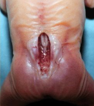 Otvorena spina bifida (aperta)